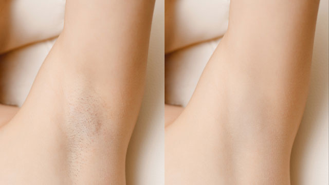 IPL Hair Removal
